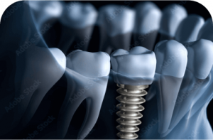 implant crown