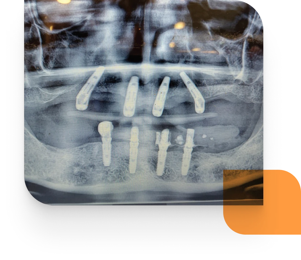 All on X course xray - ADI